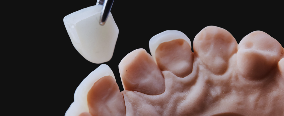Facetas Dentárias